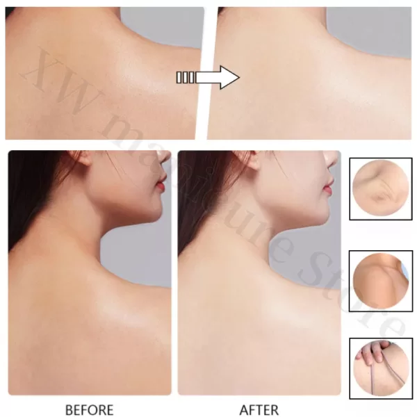 Whitening Removing Freckles Diluting Acne Spots Reducing Melanin Brightening Skin - Image 3