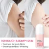 Body Cream Chicken Skin Removal Treatment Keratosis Lotion Pilaris Moisturizer Care - Image 2