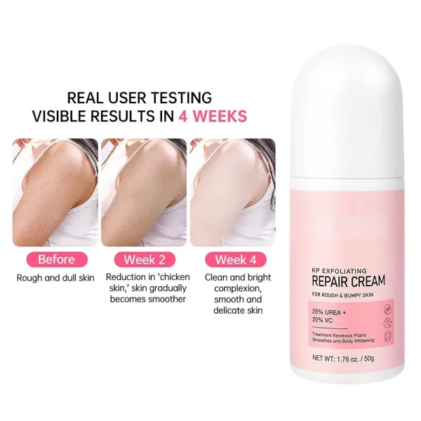 Body Cream Chicken Skin Removal Treatment Keratosis Lotion Pilaris Moisturizer Care