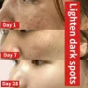 Whitening Removing Freckles Diluting Acne Spots Reducing Melanin Brightening Skin - Image 2