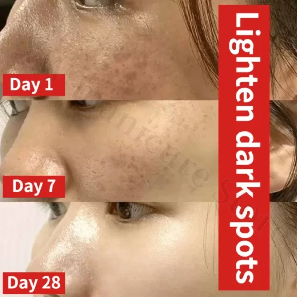 Whitening Removing Freckles Diluting Acne Spots Reducing Melanin Brightening Skin