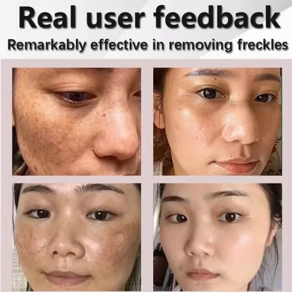 Powerful Dark Spot Remover Cream Whitening Body Lotion Lighten