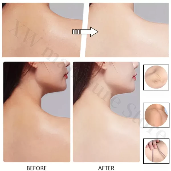 Whitening Removing Freckles Diluting Acne Spots Reducing Melanin Brightening Skin